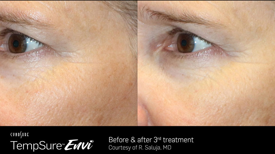 TempSure Envi Before & After | Dry Eye & TempSure Envi